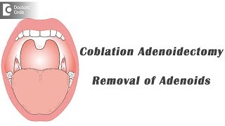 Adenoidectomy [upl. by Lemak]