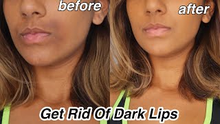 How To Get rid Of Dark Lips And Pigmentation [upl. by Yllas]