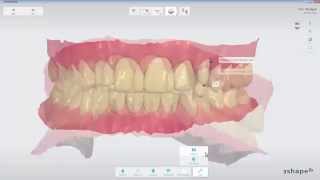 3Shape TRIOS  Analyze Page Tools [upl. by Sankaran271]