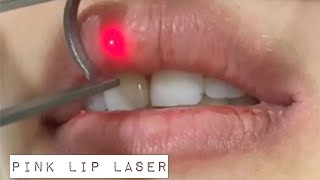 Lip Lightening Laser Treatment [upl. by Askari]