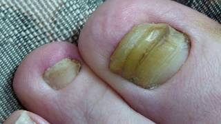 Is clotrimazole good for toenail fungus [upl. by Minne]