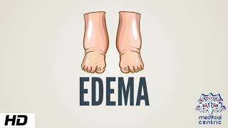 Edema Causes Signs and Symptoms Diagnosis and Treatment [upl. by Eelarbed]