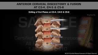 Anterior Cervical Discectomy amp Fusion at C34 C45 amp C56 [upl. by Yornek]