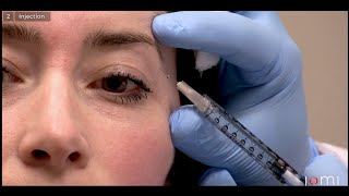 Chapter 1Botox injections in forehead [upl. by Spohr591]