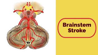 Posterior Cerebral Artery Stroke [upl. by Wanfried]