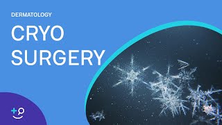 Cryo Surgery Procedure Freezing [upl. by Yuji]