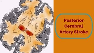 What Causes a Stroke [upl. by Dari]