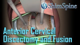 Anterior Cervical Discectomy and Fusion [upl. by Sadonia]