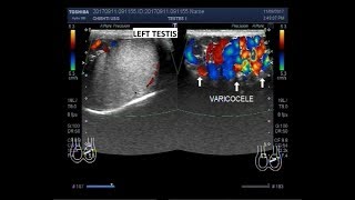 Varicose Vein Treatment  Steves VenaSeal Story [upl. by Rehtaeh888]