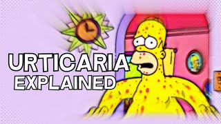 What is Urticaria Hives  EXPLAINED IN 3 MINUTES [upl. by Edlihtam520]