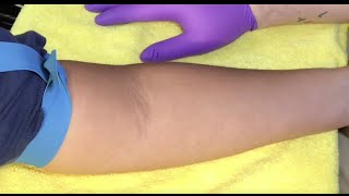 Tips For Locating Difficult Veins [upl. by Tristas]